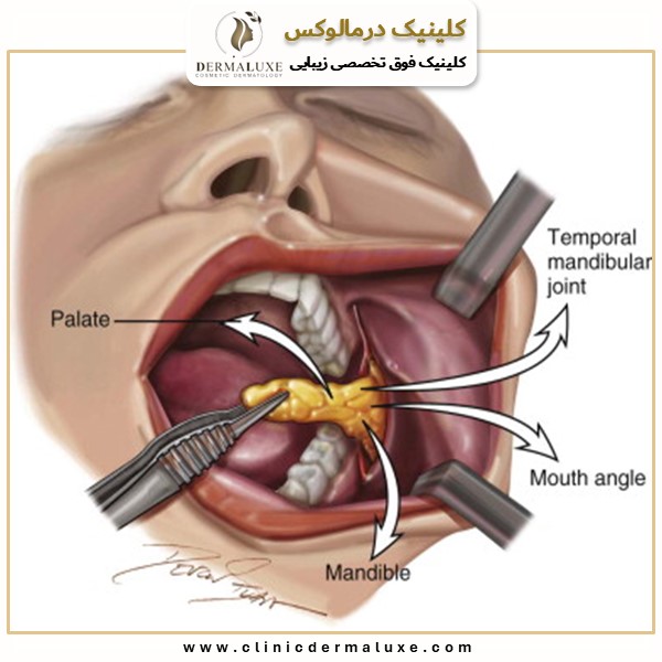 نحوه ی عمل بوکال فت چگونه است