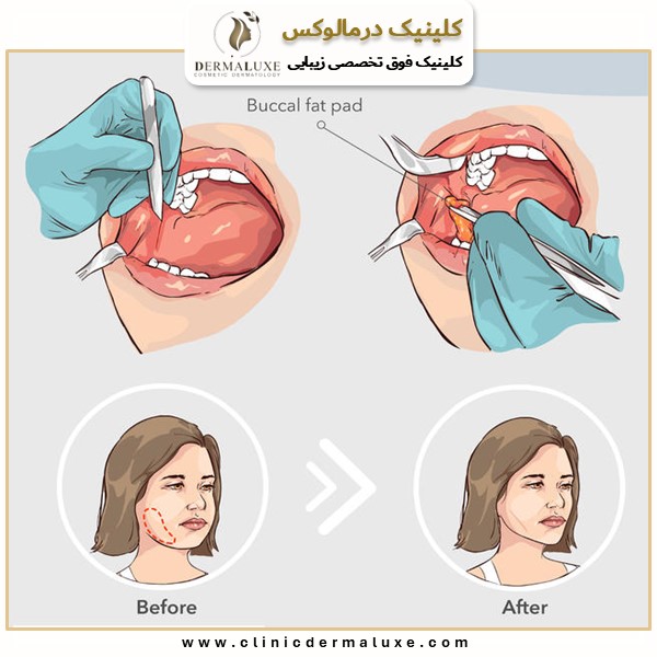 عوارض بوکال فت چیست