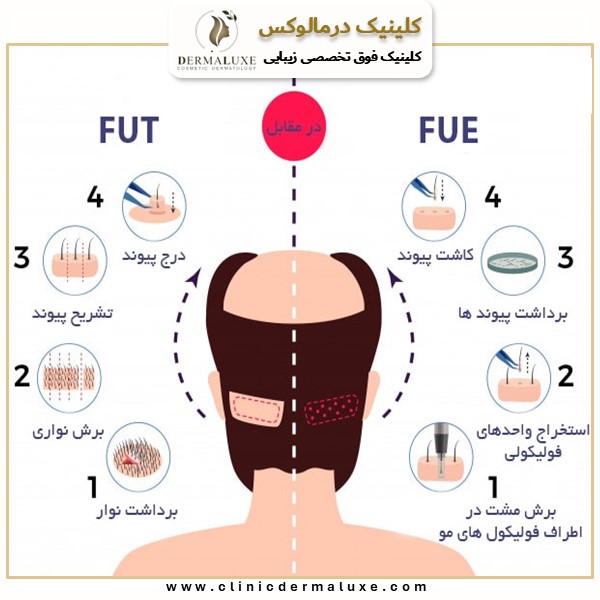 روش میکروگرافت کاشت مو