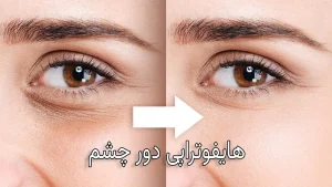 هایفو دور چشم