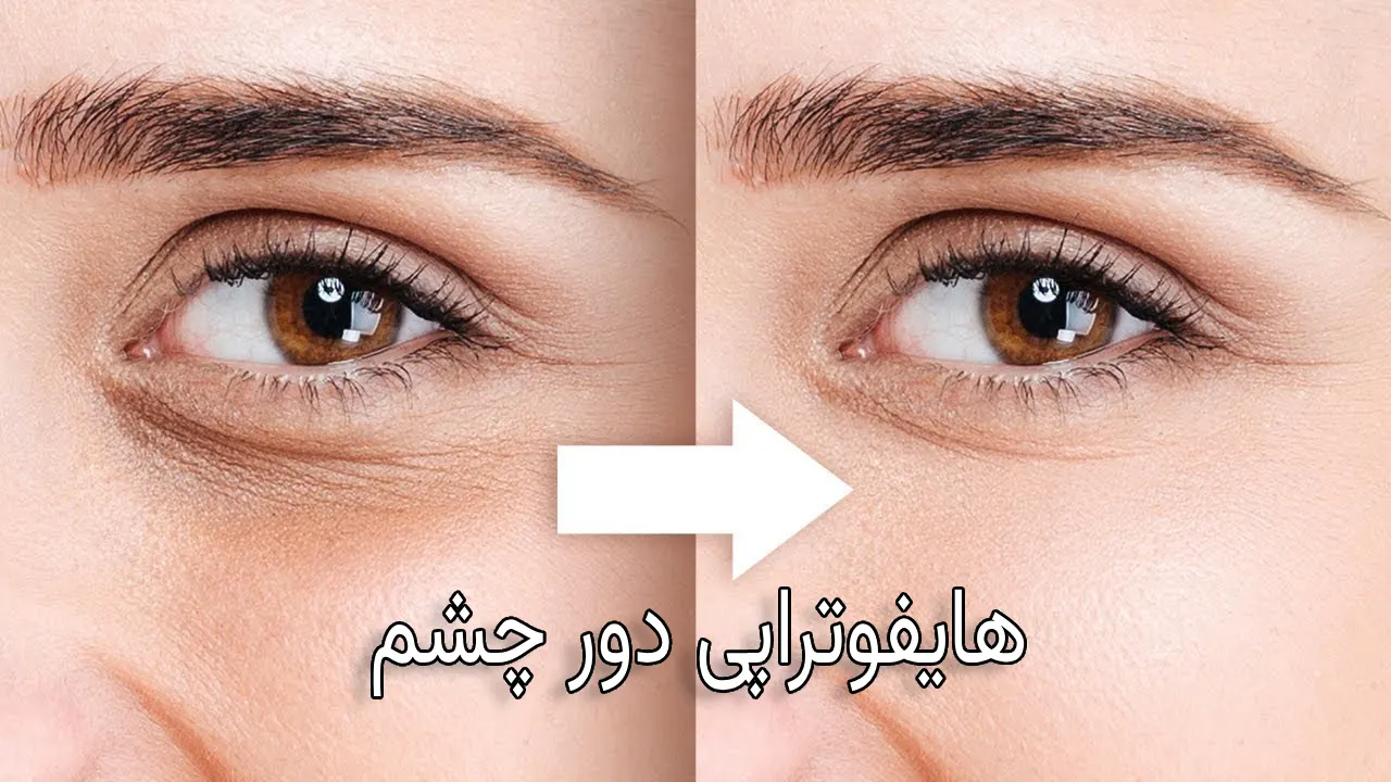 هایفو دور چشم