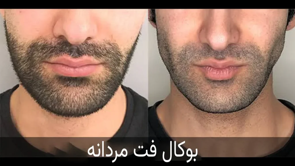 بوکال فت مردان - کلینیک درمالوکس کرج