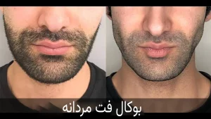 بوکال فت مردان - کلینیک درمالوکس کرج